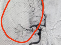 Тромб из головного мозга «вынули» волгоградские хирурги пациентке, которой неожиданно стало плохо