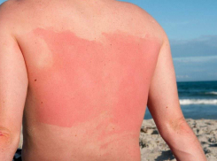 После шести часов на пляже с беспечной мамой пятилетний ребенок попал в ожоговое отделение