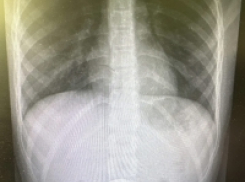 Врачи спасли ребенка, проглотившего 5-рублевую монету