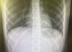 Врачи спасли ребенка, проглотившего 5-рублевую монету