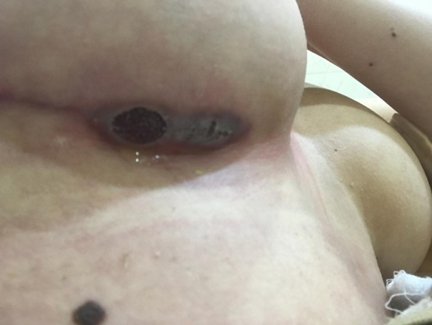 Девушка лишилась груди после ее увеличения до 3 размера в клинике «Эстетическая хирургия», - «Блокнот Волгограда"