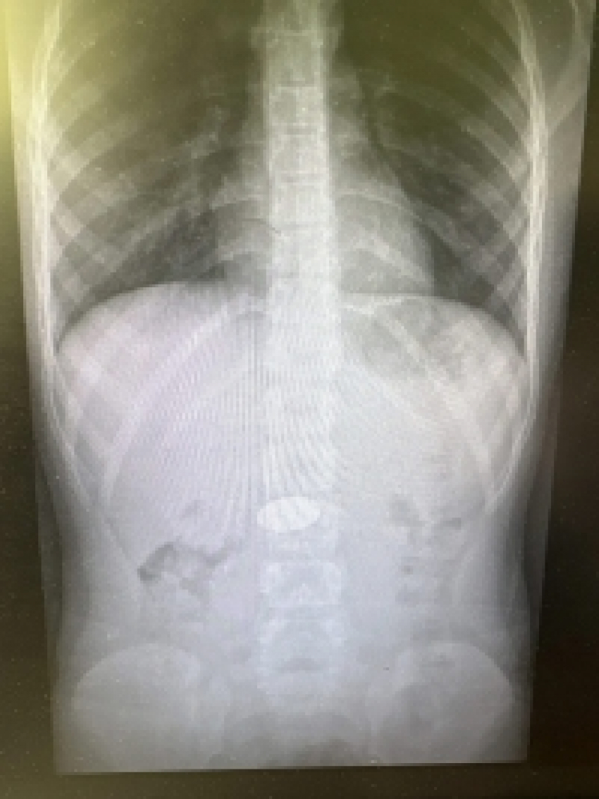 Врачи спасли ребенка, проглотившего 5-рублевую монету